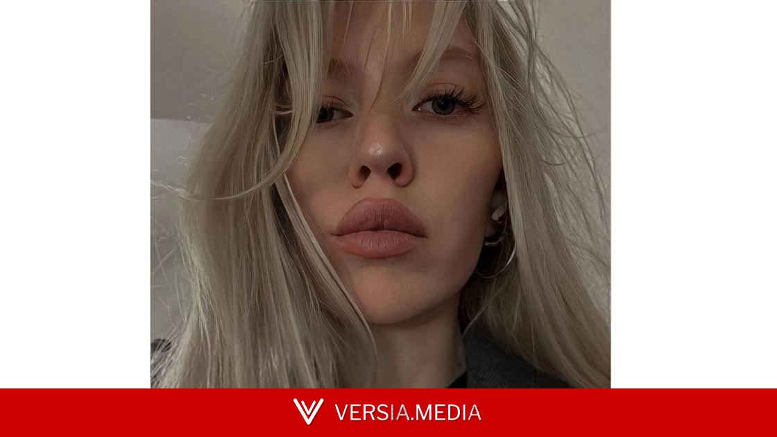 27-летняя Анастасия Прокофьева, которую бывший облил кислотой: «Глаз был насквозь прожжен, поэтому его удалили»